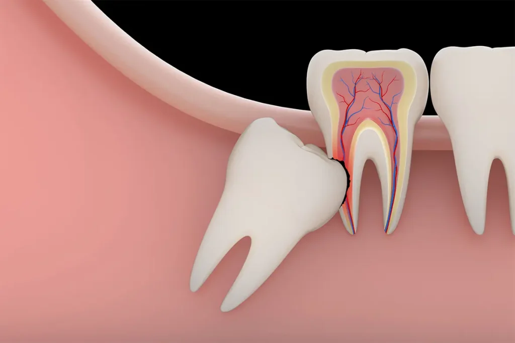 General extractions & Wisdom tooth removals