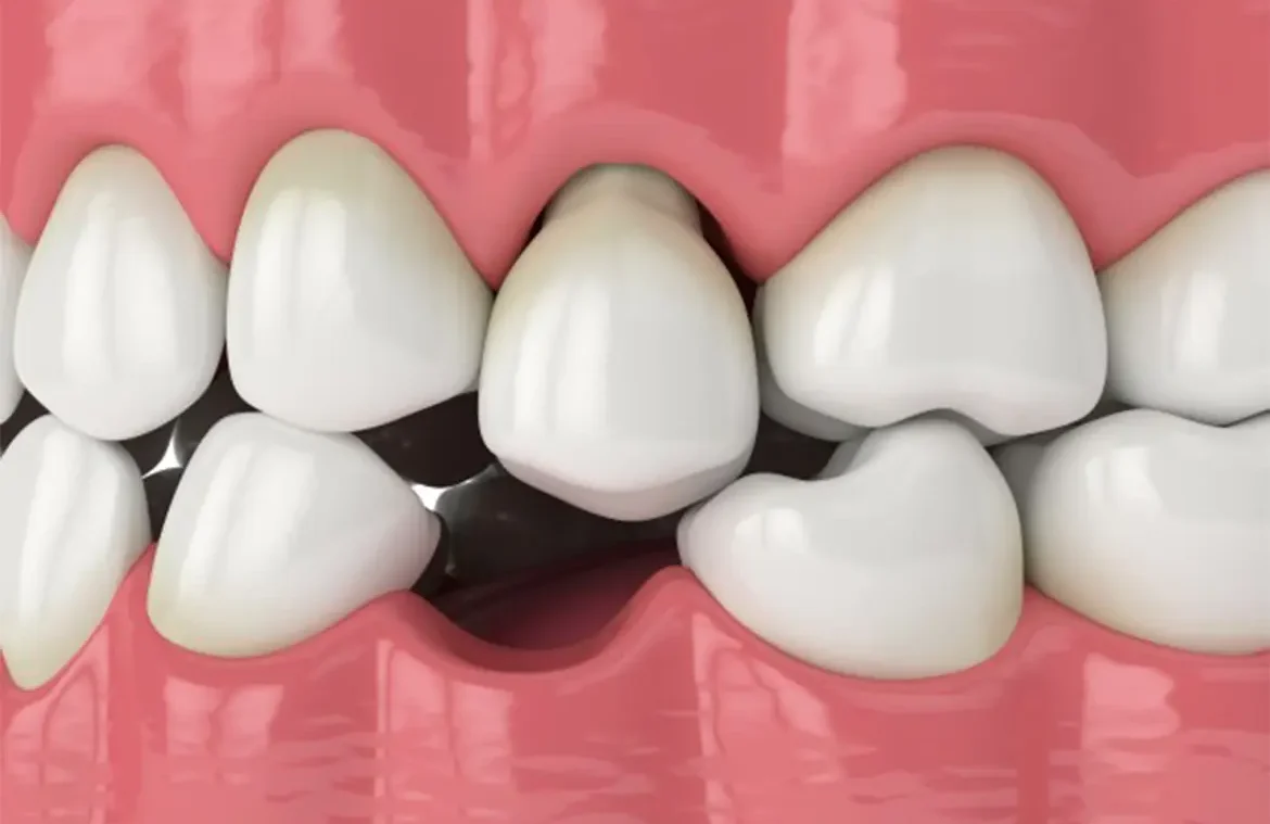 Missing teeth replacements